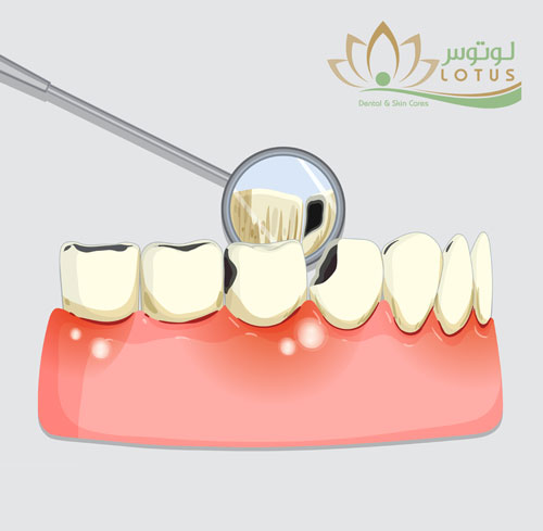 ترمیم دندان (کامپوزیت نوری)